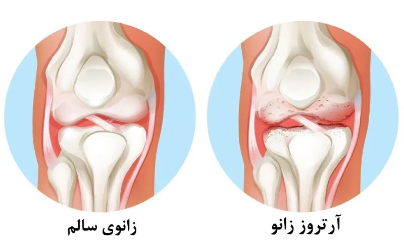 مراحل پیشرفت بیماری آرتروز زانو