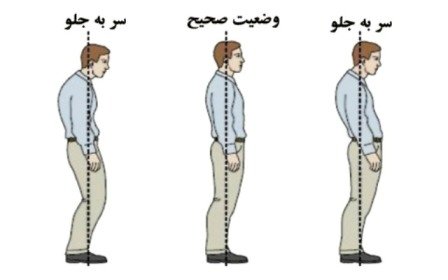 علت ناهنجاری سر به جلو