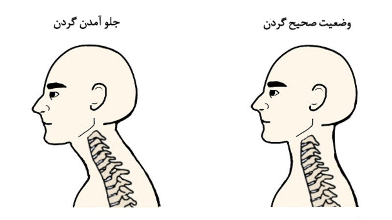 دلایل اصلی ایجاد سر به جلو در زندگی مدرن