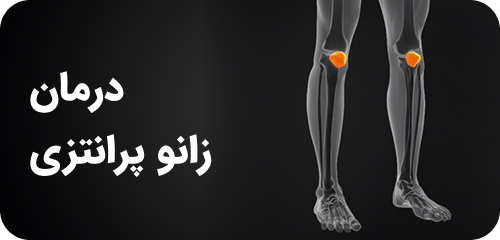 درمان زانو پرانتزی